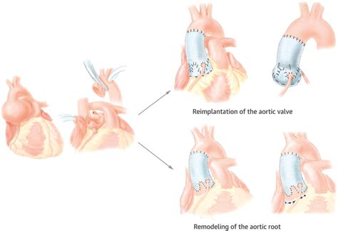 Valve Sparing Aortic Procedures The David Reimplantation Procedure