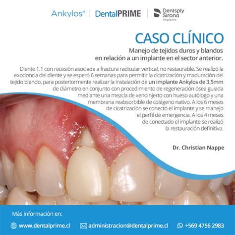 Caso Cl Nico Dr Christian Nappe Dental Prime