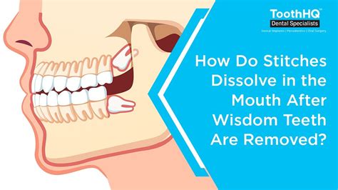 How Long To Gauze After Wisdom Teeth Removal At Roger Myers Blog