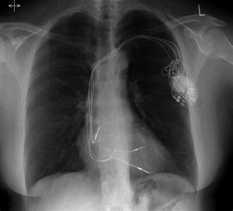 Chronic Ventricular Lead Perforation Expect The Unexpected Sidhu