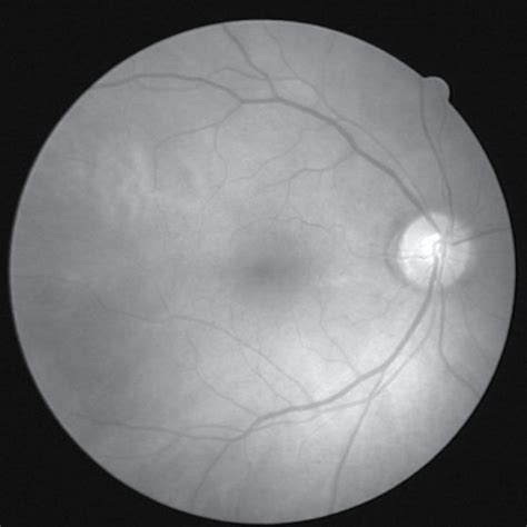 The Comparison Of Blood Vessel Segmentation Effect Of Fundus Retinal