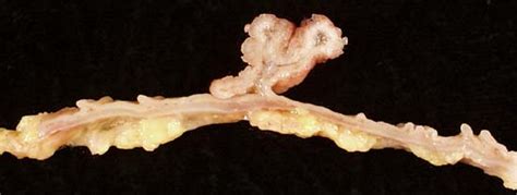 Colon polyps pathophysiology - wikidoc