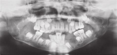 Panoramic Radiograph Showing Multilocular Lesions In The Mandible No