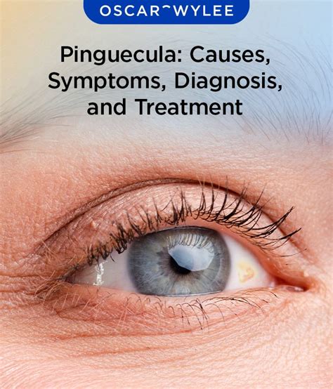 Pinguecula Causes Symptoms Diagnosis And Treatment