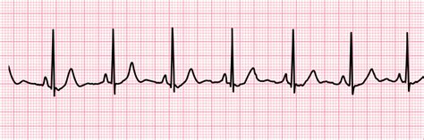 Normal-Sinus-Rhythm - theOrcasonian.com