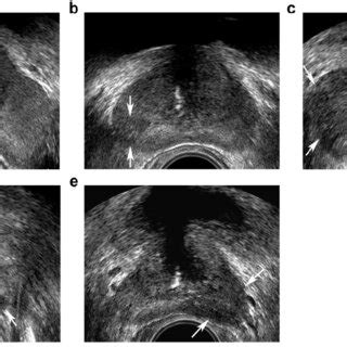 Transrectal Ultrasound Five Grade Scoring System On Doppler Imaging A