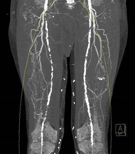 Runoff Using Dual Energy With Bone And Calcium Removal Shows Extensive