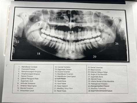 Flashcards Pano Landmarks Radiology Quizlet