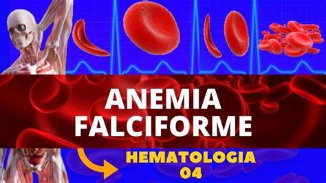 Anemia Falciforme Anemia Heredit Ria Hematologia Youtube