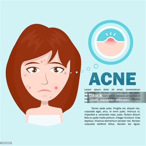 Acne Infographic Vector Modern Flat Style Cartoon Character