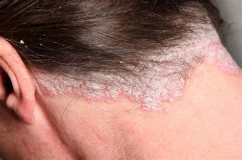 Scabs on Scalp: Causes, Treatment & Remedies | Treat, Cure Fast