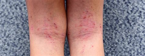 Dupixent How It Works To Treat Atopic Dermatitis Elect Dermatology