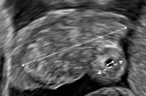 How To Measure Size Of Tubal Ectopic Pregnancy On Ultrasound Rajah 2018 Ultrasound In