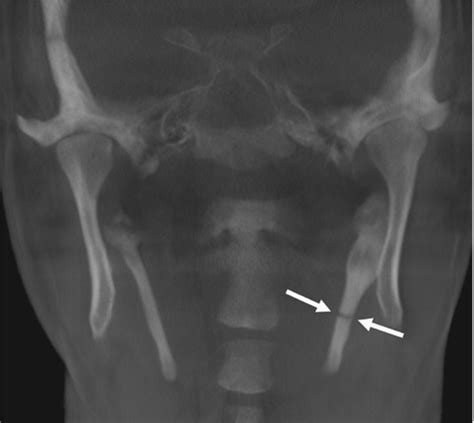 Fractured Styloid Process Masquerading As Neck Pain Cone Beam Computed