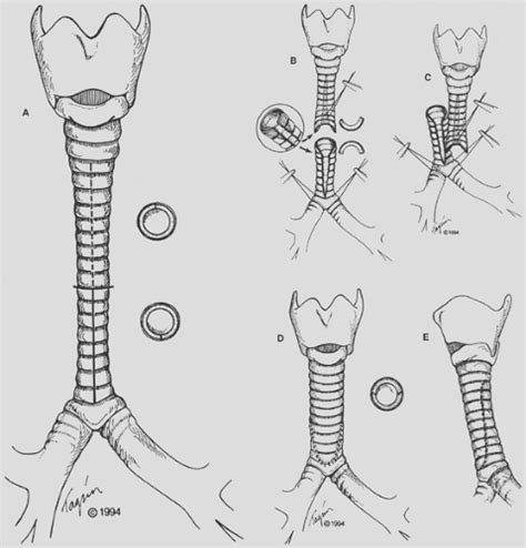 Surgical Anatomy Of The Trachea And Techniques Of Resection And