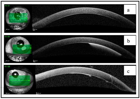 Jcm Free Full Text Descemet’s Membrane Detachment During Phacocanaloplasty Case Series And