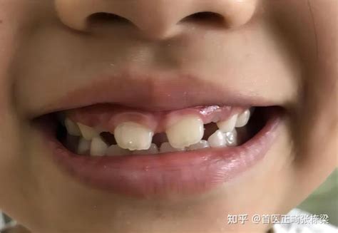 儿童替牙期门牙牙缝大正常吗？需要早期矫正干预吗？ 知乎