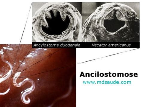 Ancilostomose Transmissão Sintomas E Tratamento Mdsaúde