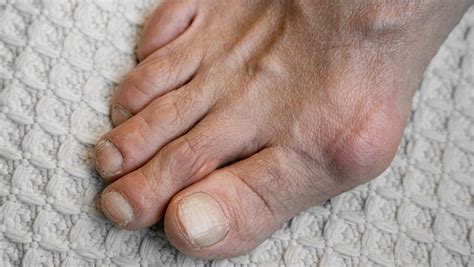 Hallux Rigidus Arthrose Verursacht Schmerz Im Gro En Zeh Ndr De