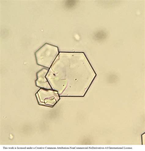 Classic Hexagonal Appearance of Cystine Crystals on Urine Microscopy ...