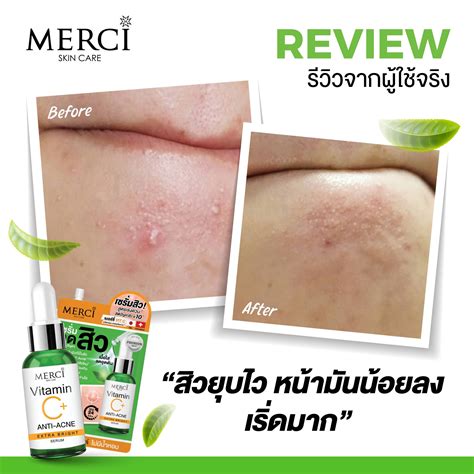 เซตคู่ ลดสิว ผิวใส เมอร์ซี่ เซรั่มลดสิว และเจลใสล้างหน้า Merci Skincare