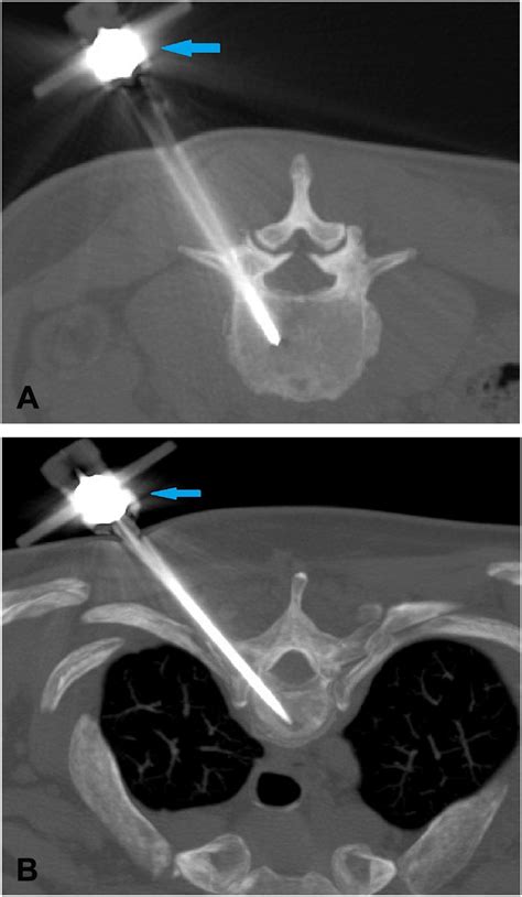 Comparative Analysis Of Ct Guided Vertebral Biopsy By A Conventional Bone Biopsy Needle Versus