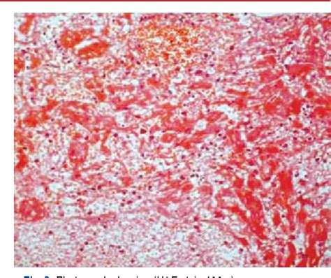 Figure From Capillary Hemangioma Of The Maxillary Sinus A Case