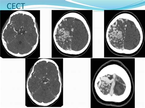 Cerebral Pial Arteriovenous Malformation Avm Ppt