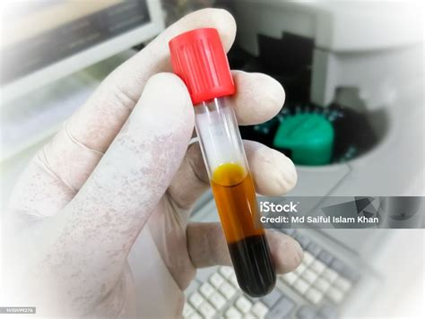 Scientist Hold Test Tube With Icteric Serum For Test In Laboratory