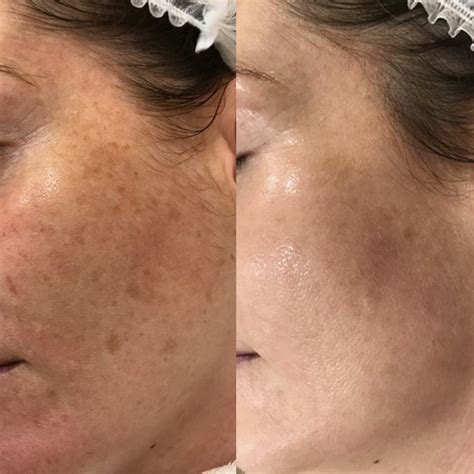 Laser Pigmentation Removal Skiin Clinic