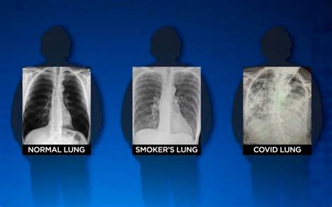 Pulmones De Enfermos Covid Peores Que Los De Fumadores El Sol De