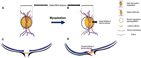 The Anatomic Change During Myopic Tilted Disc Development Panels A C