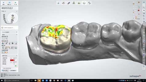 3shape软件下颌7号牙设计方法哔哩哔哩bilibili