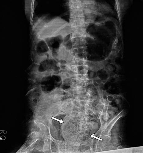 A Break In The Wall Faecaloma And Stercoral Proctitis British Journal Of Hospital Medicine