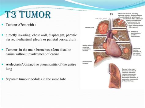 Ppt Lung Cancer Staging Powerpoint Presentation Free Download Id4678509