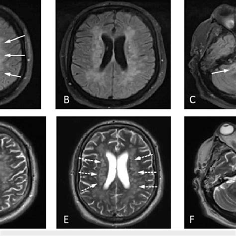 MRI Brain Axial FLAIR A C And Axial T2WI D F Demonstrate