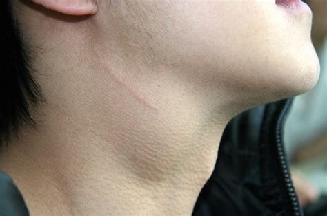 Epidermoid Cysts Neck