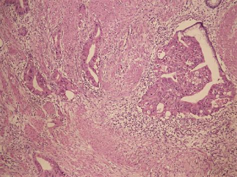 Photomicrography Of The Primary Colon Adenocarcinoma Which Is