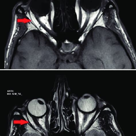 Orbital MRI Shows That The Right Lateral Rectus Muscle Is Atrophic Red