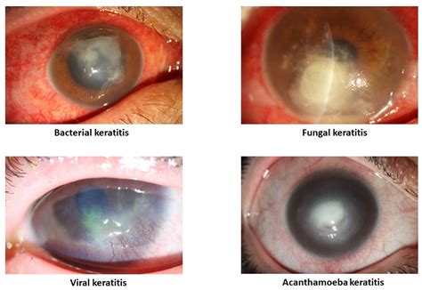 Life Free Full Text Artificial Intelligence And Infectious Keratitis Where Are We Now