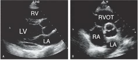 Aortic Valve Disease Thoracic Key