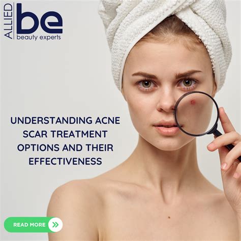 Understanding Acne Scar Treatment Options And Their Effectiveness Allied Beauty Experts