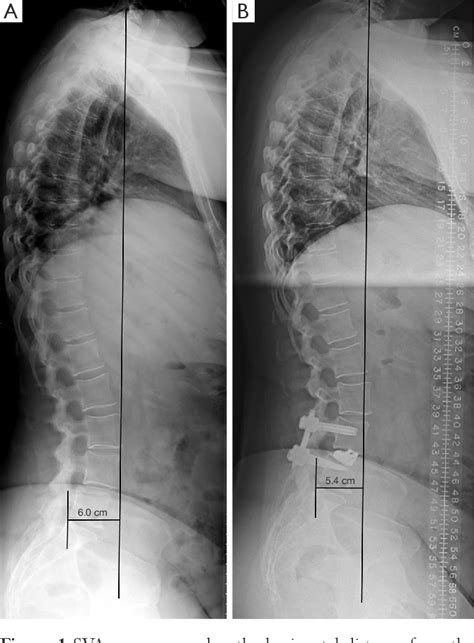 Figure 1 From The Influence Of Sagittal Spinopelvic Alignment On