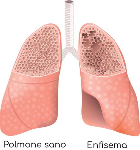 Enfisema Polmonare Sintomi Cause Cura Ed Aspettativa Di Vita