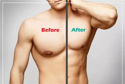 Gynecomastia Surgery In Antalya Medgol