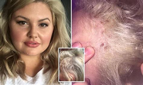 Woman Left With Horrific Burns After Having Her Regrowth Touched Up Chemical Burn Treatment