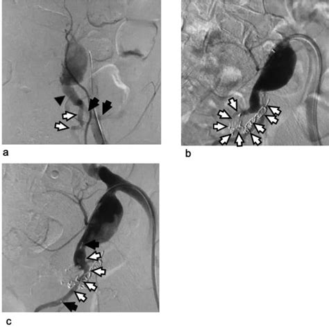 Arteriogram Of The Left Internal Iliac Artery During The Embolization