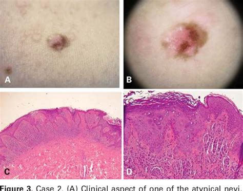 Figure From Dermoscopy In Epidermodysplasia Verruciformis Semantic