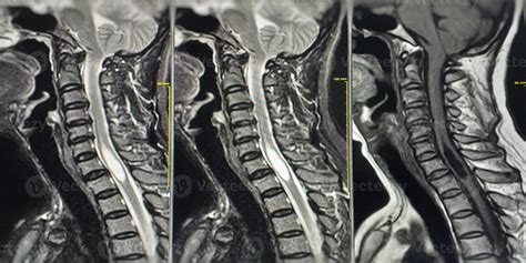 Mri C Spine Muestra Una Masa En La Cara Posterolateral Izquierda Del