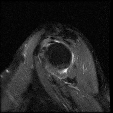 Adhesive Capsulitis With Rotator Cuff Tendinopathy Image